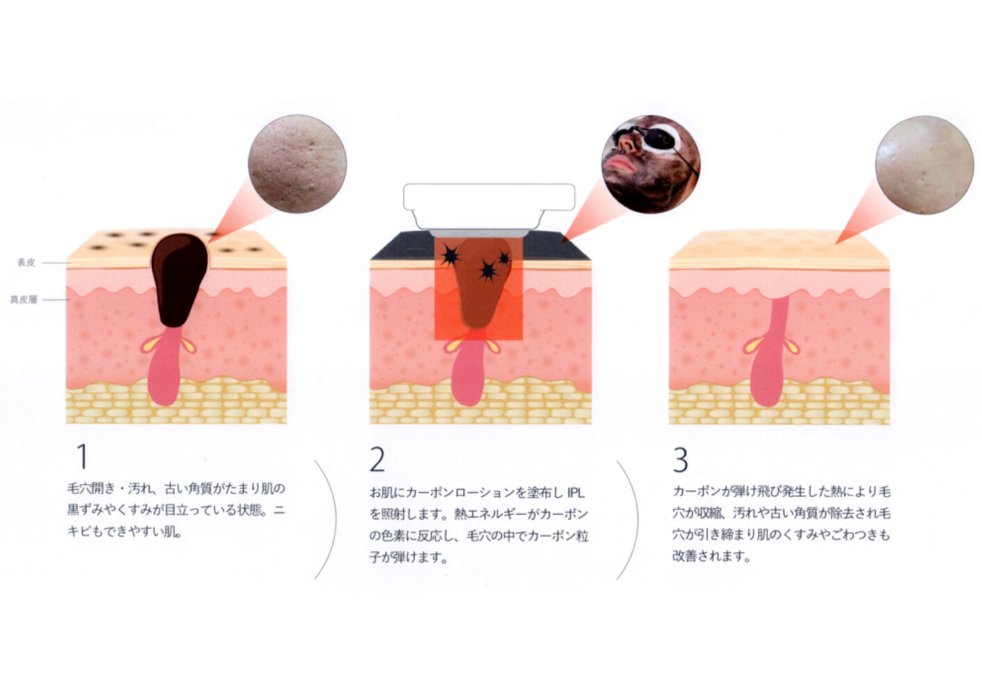 米子のエステサロンHIKARI,フェイシャル エステ